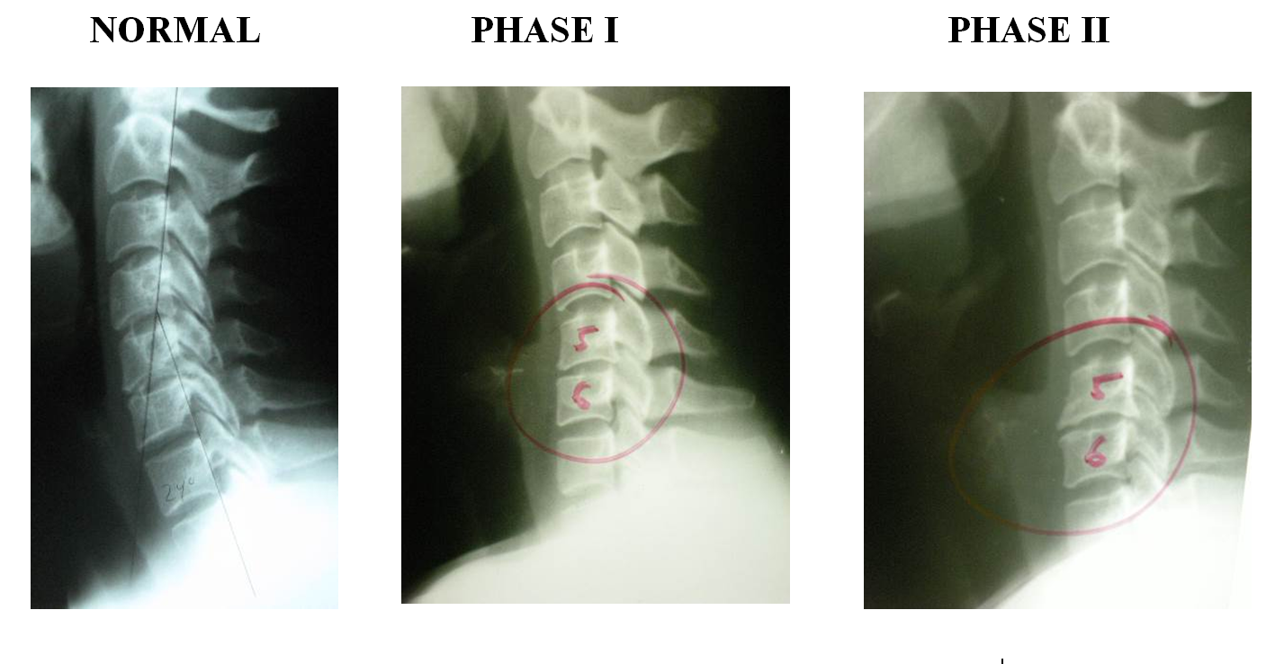 It's Just a Little Arthritis…Right? DMChiropractic